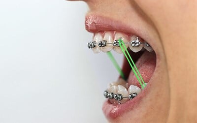 Elastics (Rubber Bands)