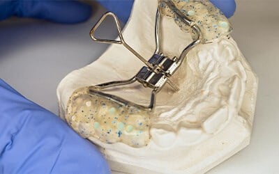 Palatal Expander