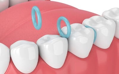 Separators or Spacers